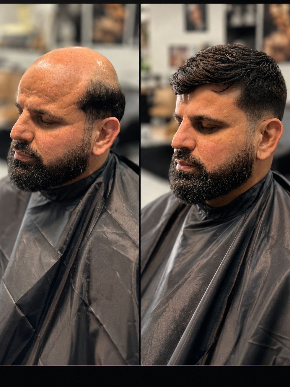 Antes e depois — prótese capilar masculina, caso 01