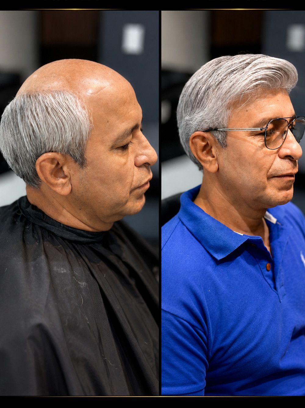 Antes e depois — prótese capilar masculina, caso 02