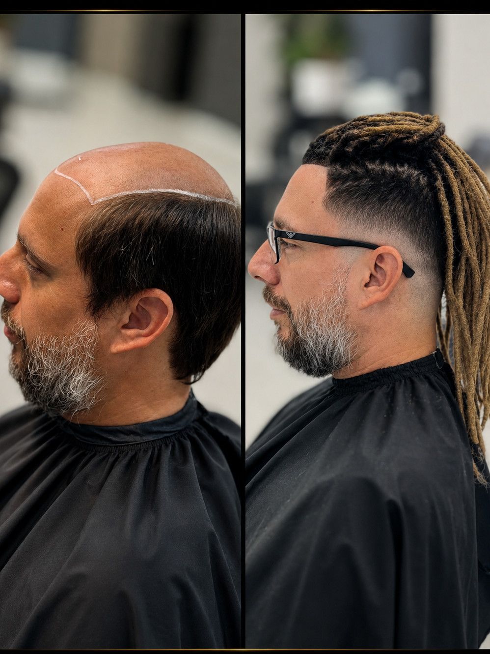 Antes e depois — prótese capilar masculina, caso 03